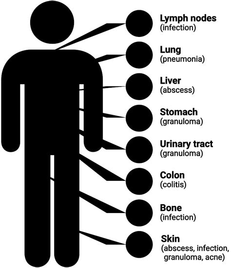 Chronic Granulomatous Disease Symptoms | ACTIMMUNE® (Interferon gamma-1b)