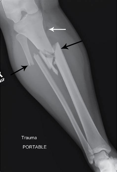 Comminuted fracture tibia and fibula - ratinggrag