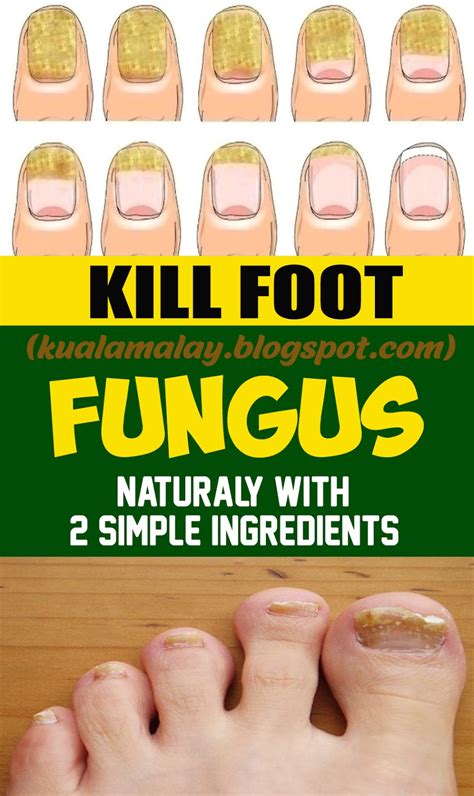 Best and Simple Home Remedy to Remove Toenail Fungus