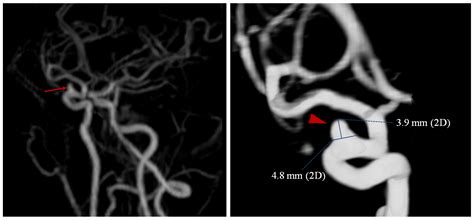 Cerebral Aneurysm Angiogram