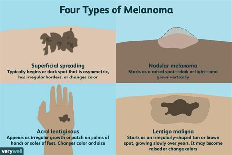 Acral Lentiginous Melanoma Nail Symptoms - Nail Ftempo