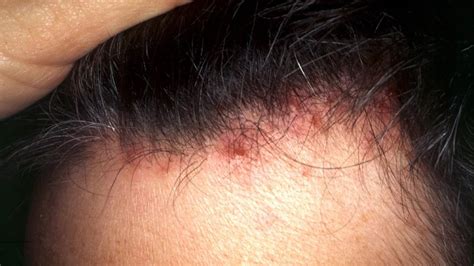 Scalp folliculitis: Symptoms, pictures, causes, shampoos and creams