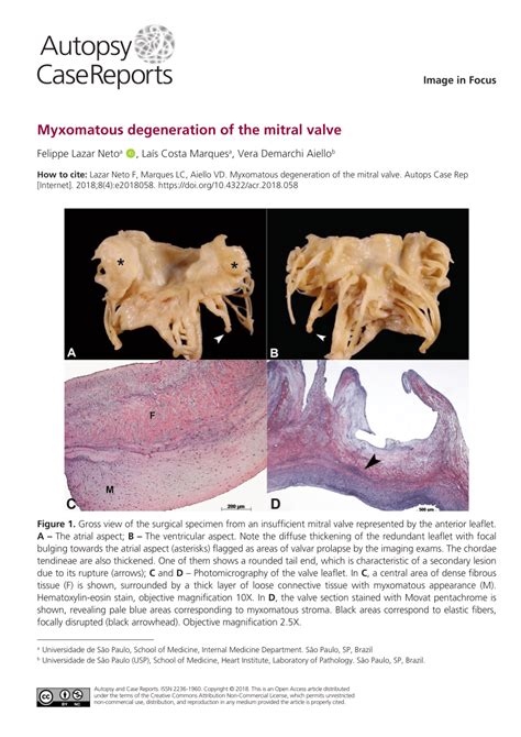 Myxomatous Mitral Valve Disease