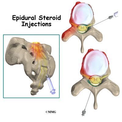 Epidural Steroid Injections - eOrthopod.com