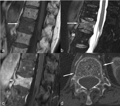 Hemangioma Mri