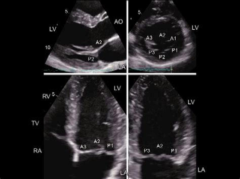 Mitral Valve Echocardiography