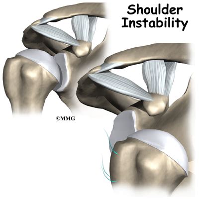 Shoulder Instability - Orthopedic Surgery, Algonquin, IL, Barrington ...