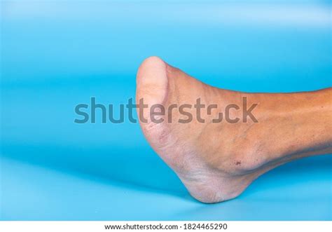 295 Toe Amputation Images, Stock Photos & Vectors | Shutterstock