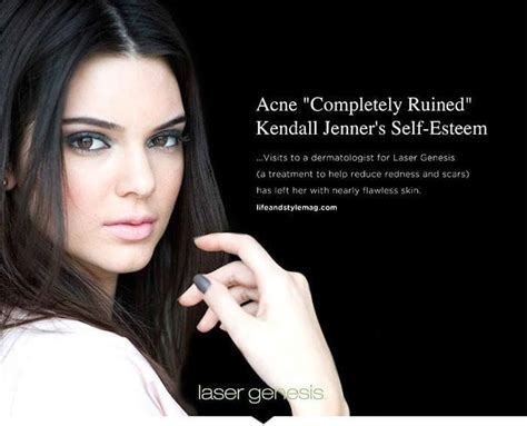 Acne Scar Treatment FAQ's - Your Trusted Med Spa in Corte Madera