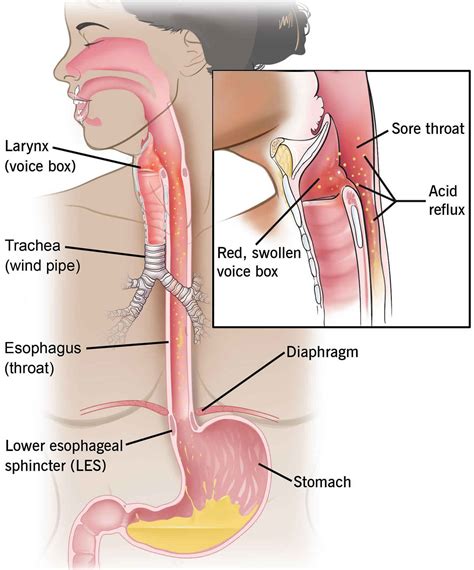 Esophageal stricture causes, symptoms, diagnosis, treatment & prognosis