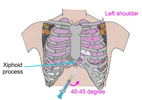 Clinical Pericardiocentesis