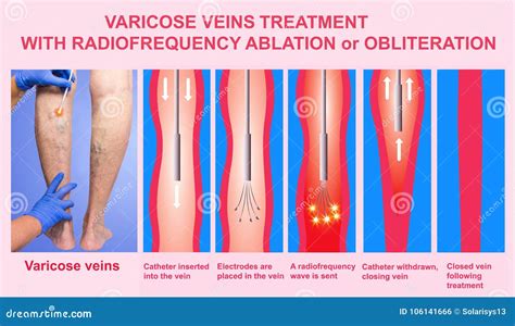 Varicose Veins and Treatment with Radiofrequency Ablation Stock Photo ...