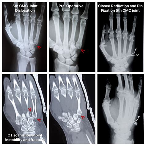 Closed Reduction and Pin Fixation of Hand Fracture-Dislocation - John ...