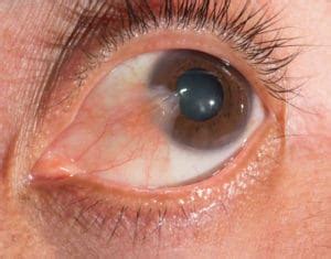 What is a pinguecula? What is a pterygium? - Mark C. Vital, M.D.