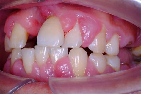 Amlodipine Induced Gingival Hyperplasia