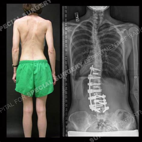 Scoliosis in Adults: What to Know About Symptoms & Treatment