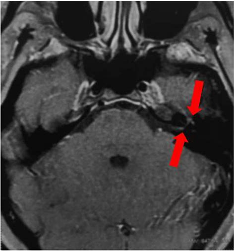 Axial brain MRI (T1/gadolinium) showing contrast enhancement in the ...