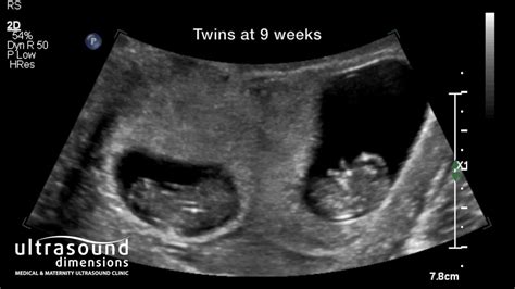 8 Week Ultrasound Fraternal Twins