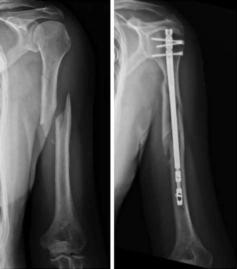 Humerus Fracture — Joseph J. Schreiber, MD