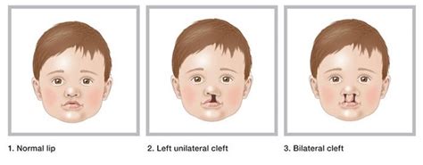 Kids Health Information : Cleft lip and cleft palate