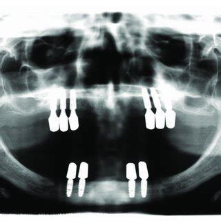 Patient 1 (panoramic radiograph performed in 2010): 10 Ankylos ...