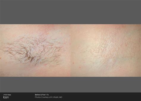 Hair Removal | before and after photo images