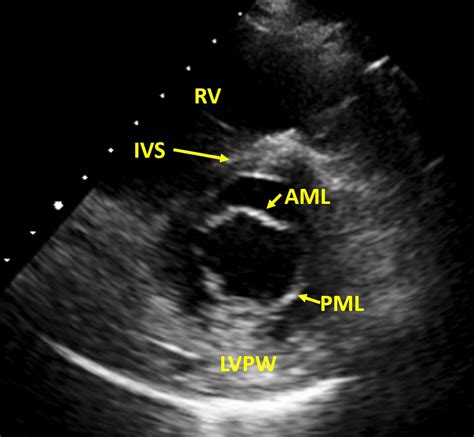 Normal mitral valve cross section on echocardiography – All About ...