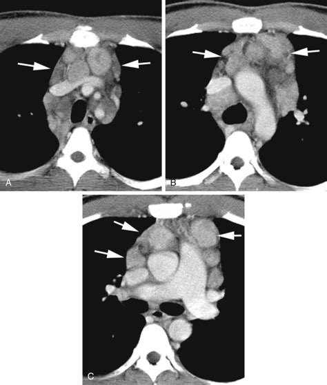 small mediastinal lymph node