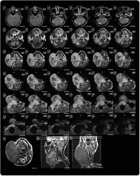 Gadolinium Mri