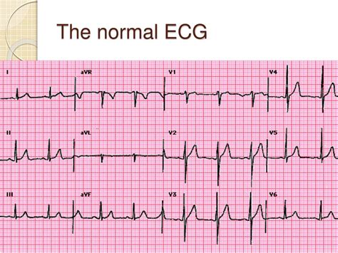 PPT - ECG interpretation for beginners - 1 PowerPoint Presentation ...