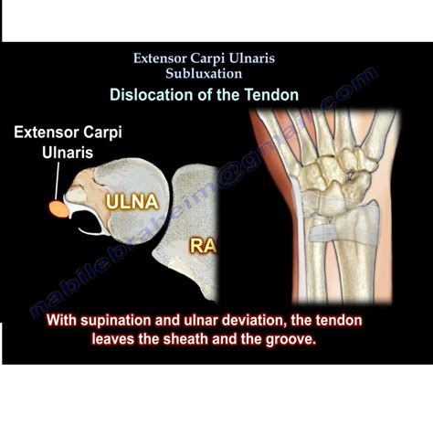 Extensor Carpi Ulnaris Subluxation — OrthopaedicPrinciples.com