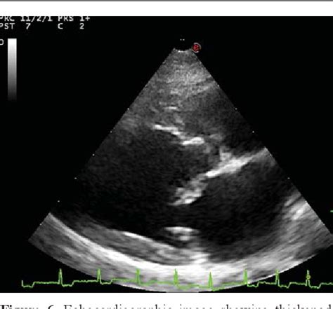 Myxomatous Mitral Valve