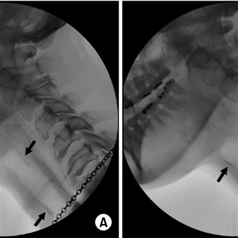 (PDF) A Perspective of the Wearing-off Phenomenon in a Patient with ...