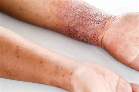 Atopic dermatitis causes, symptoms, diagnosis, treatment & prognosis