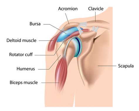 Shoulder Bursitis/Impingement | Treatment & Recovery Time