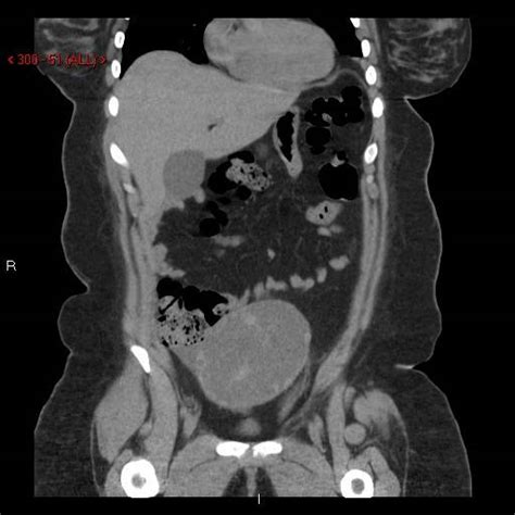 Why Ct Scan Abdomen Pelvis