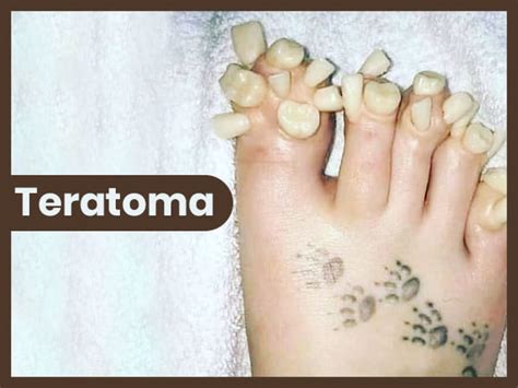 Sacrococcygeal Teratoma Teeth