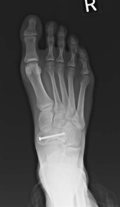 Tarsal Navicular Bone Fracture