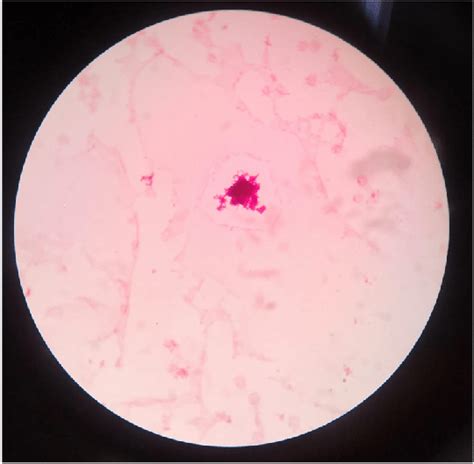 Gram stain from the blood culture showing gram positive bacilli with ...