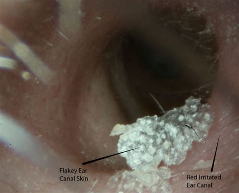 What Causes Your Ears To Itch And Drain - Best Drain Photos Primagem.Org