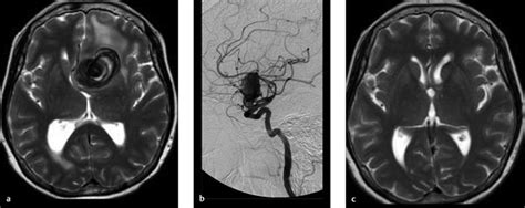 Cerebral Aneurysm Angiogram