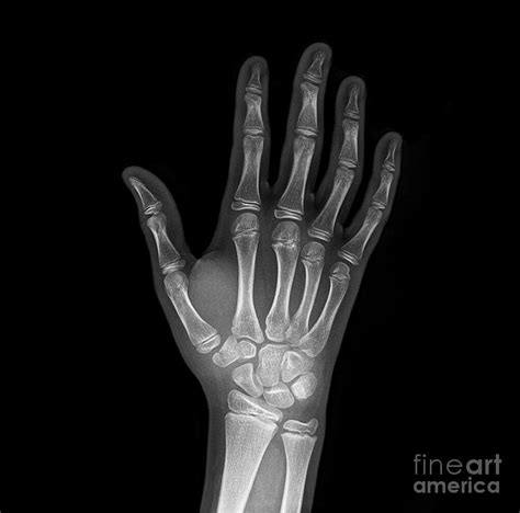 Broken Wrist Bone, X-ray Photograph by Science Photo Library