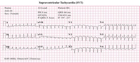 Atrial Tachycardia Causes Symptoms Diagnosis Treatment