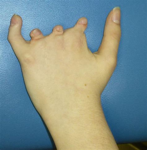 I suffer from Poland Syndrome a disability that causes your fingers to ...