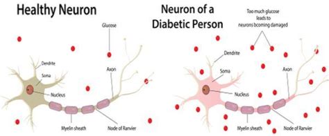 Diabetic neuropathy - Health Tips, Diabetic neuropathy Health Articles ...