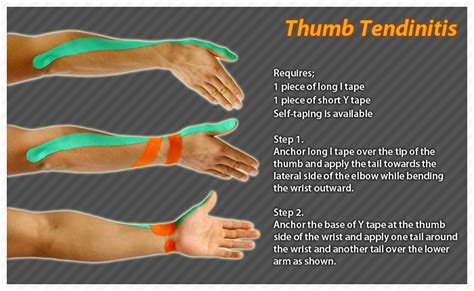 ares clinical taping - rheumatism thumb Tendinitis, Kt Tape, Wrist Pain ...