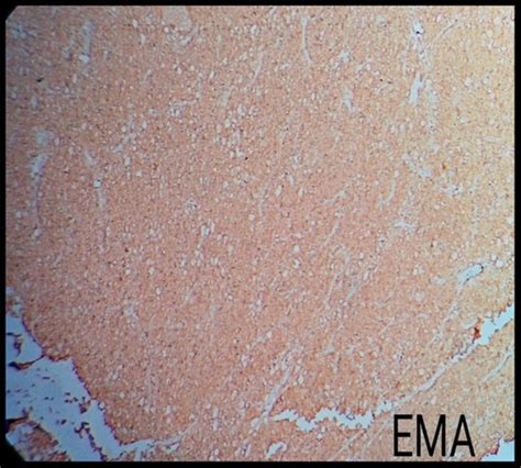 Immunohistochemical staining for chromophobe RCC was positive for ...