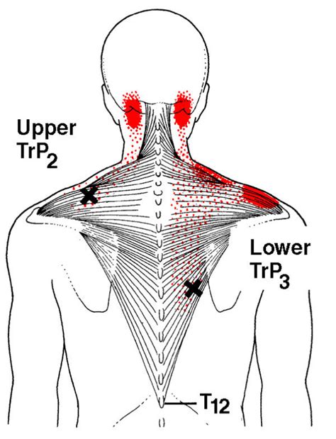 Trapezius Trigger Points