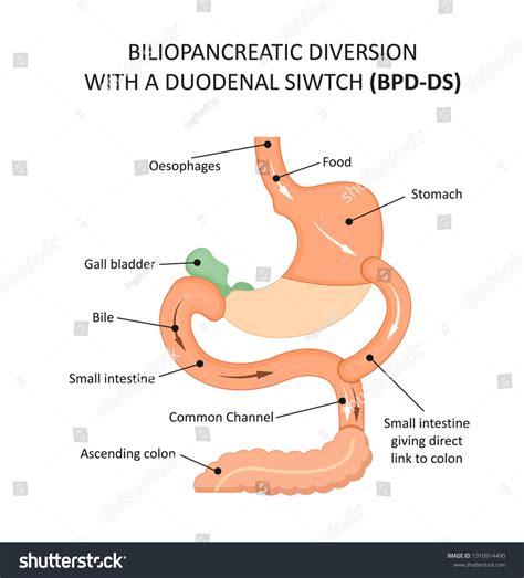 34 Duodenal Switch Stock Vectors, Images & Vector Art | Shutterstock