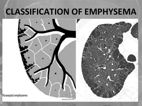 Emphysema